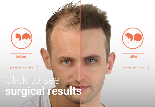 ... You Want To Have a Good View The Hair is İmportant | Hair Transplant